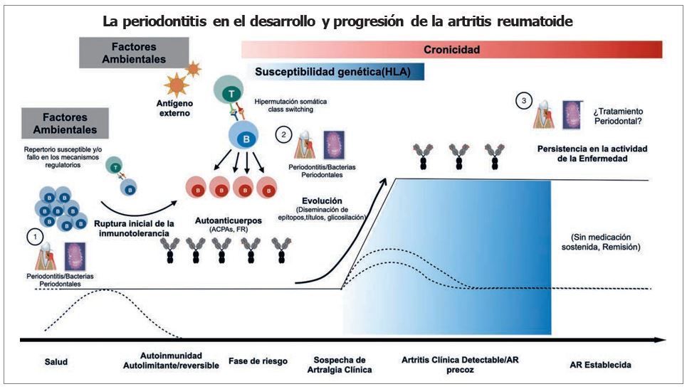 ARTRITIS REUMATOIDE Y PERIODONTITIS: ASOCIACIÓN, MANEJO E IMPLICACIONES EN LA CLÍNICA DENTAL.